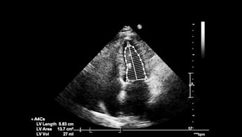 Echographie et pathologies valvulaires  mesure des principaux paramètres d’évaluation