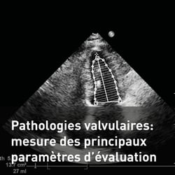 Pathologies valvulaires  mesure des principaux paramètres d’évaluation