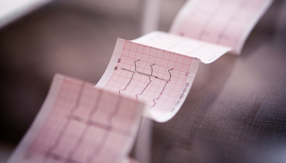Bases de l’analyse de ECG, diagnostics des bradycardies et conduite à tenir