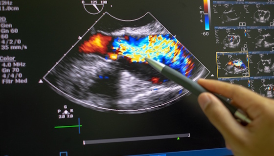 Quantification et prise en charge des valvulopathies gauches régurgitantes